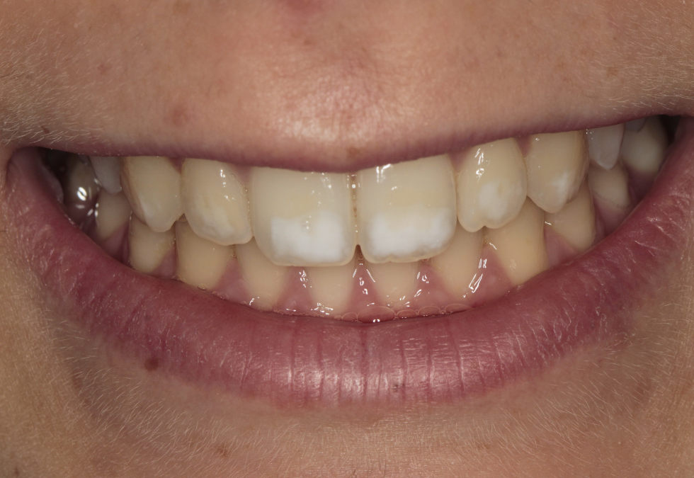 ¿Qué son las hipoplasias de esmalte?