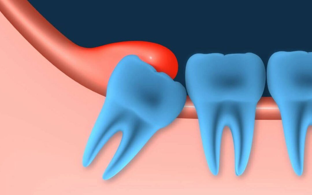 ¿Qué es la pericoronaritis? Tipos, síntomas y tratamiento