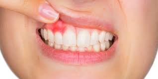 ¿Qué es la piorrea dental o enfermedad periodontal?